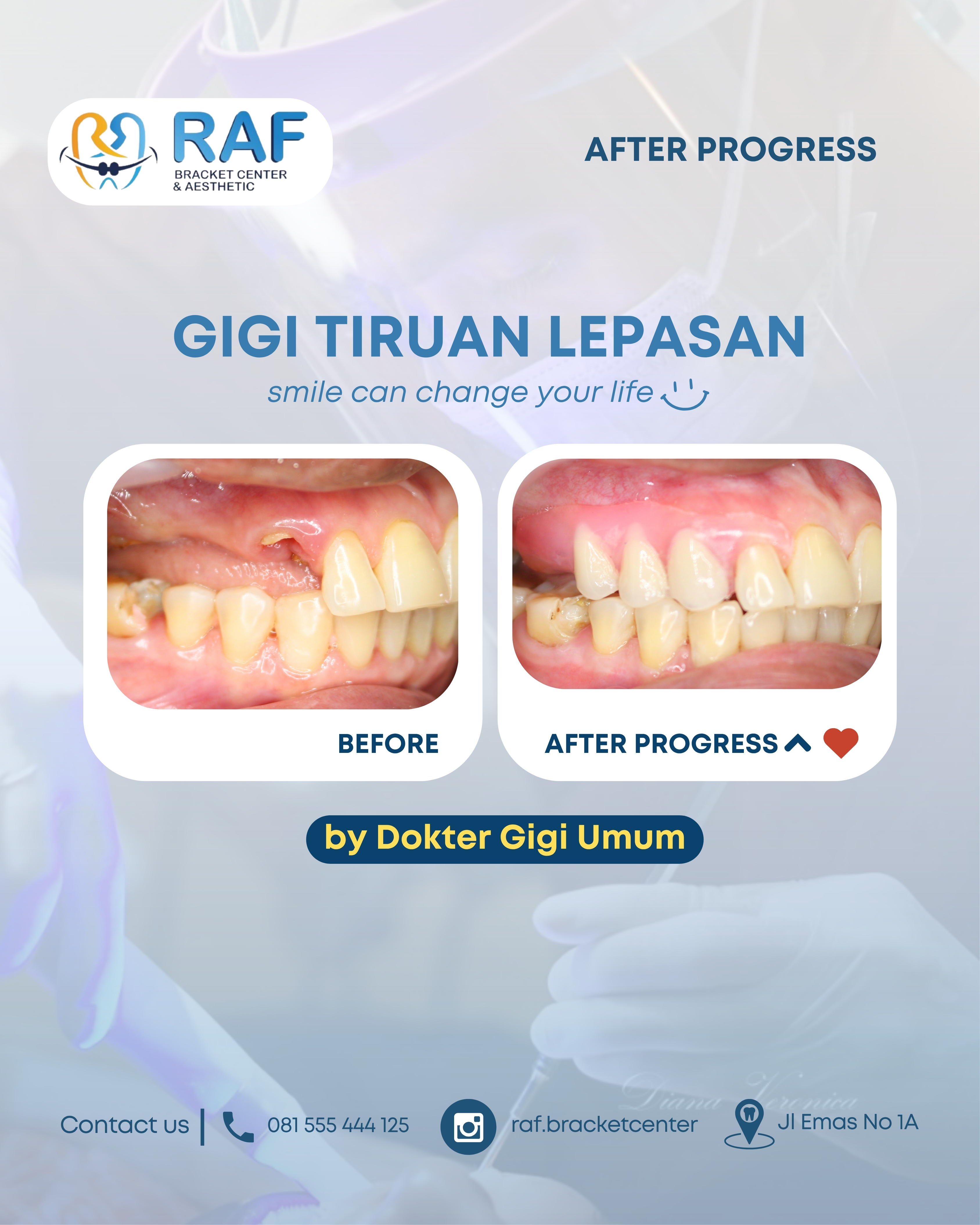 Gigi Tiruan Lepasan